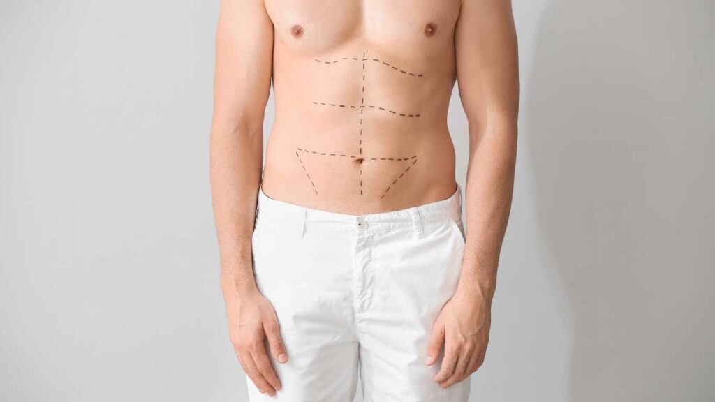 Tummy Tuck