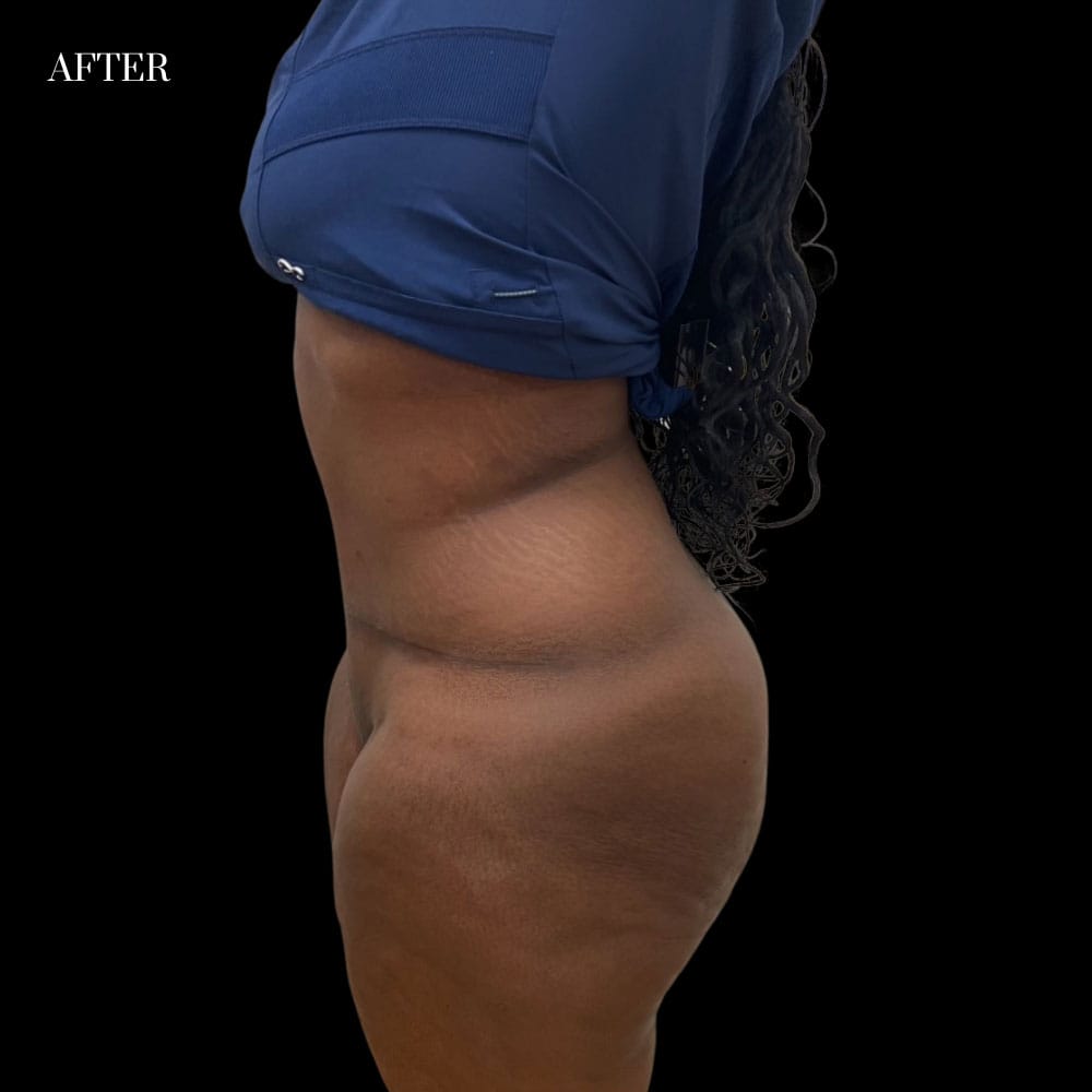 Abdominoplasty Case 2 After
