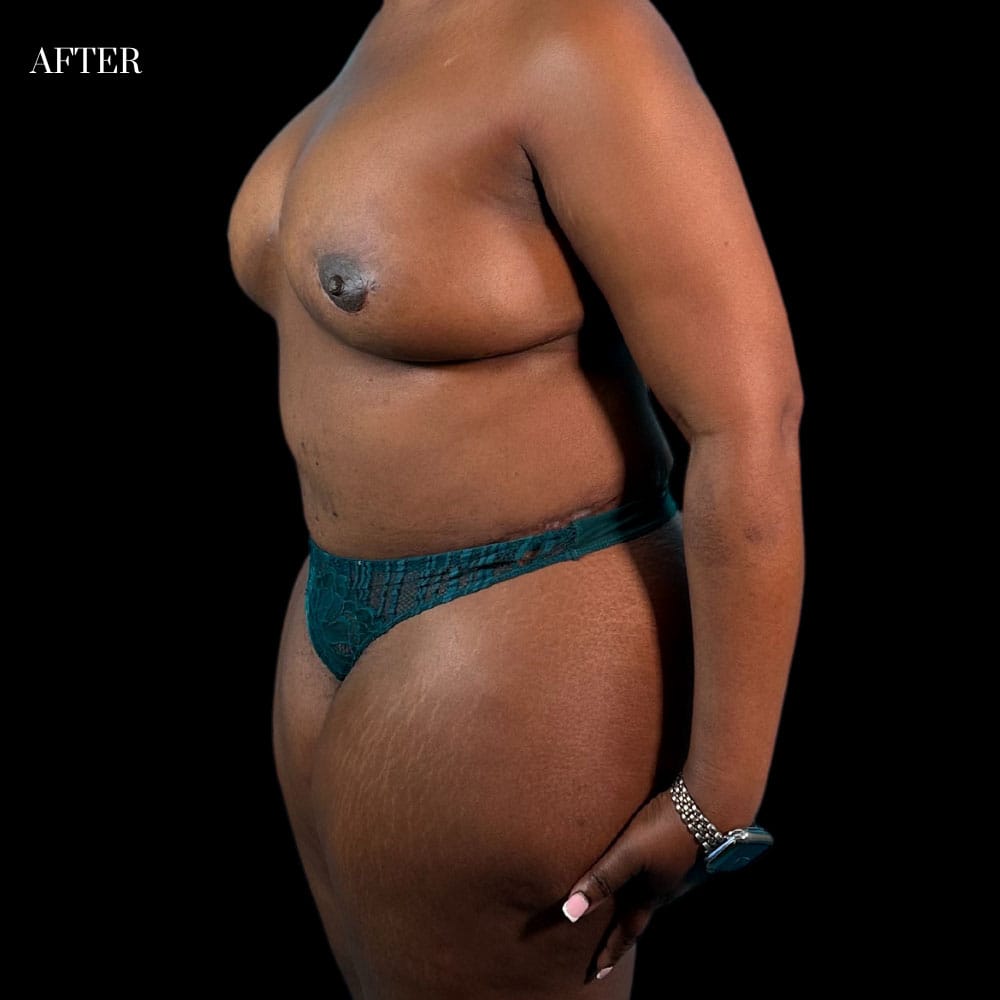 DIEP Flap Case 1.4 After