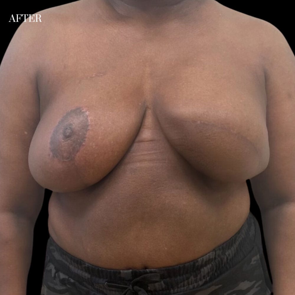 Delayed Reconstruction Case 2.1 AFter