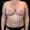 DIEP Flap Case 4.4 After