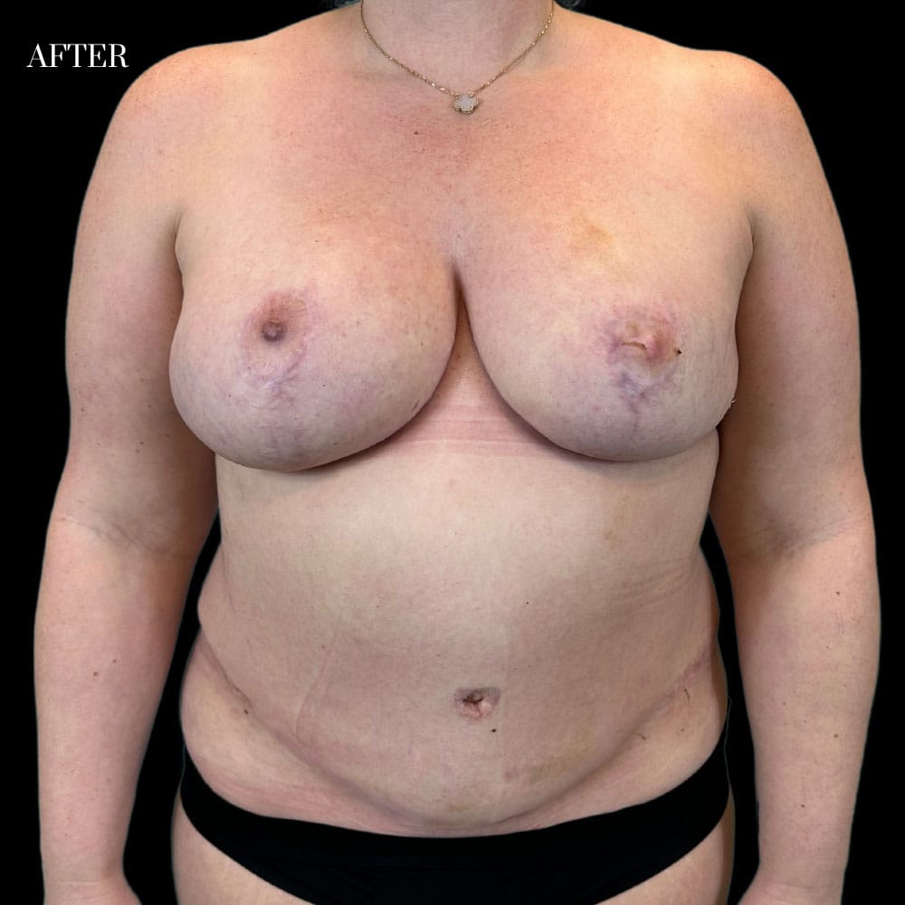 DIEP Flap Case 4.4 After