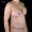 DIEP Flap Case 7.2 After