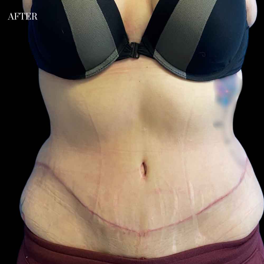 Abdominoplasty Case 1.2 After