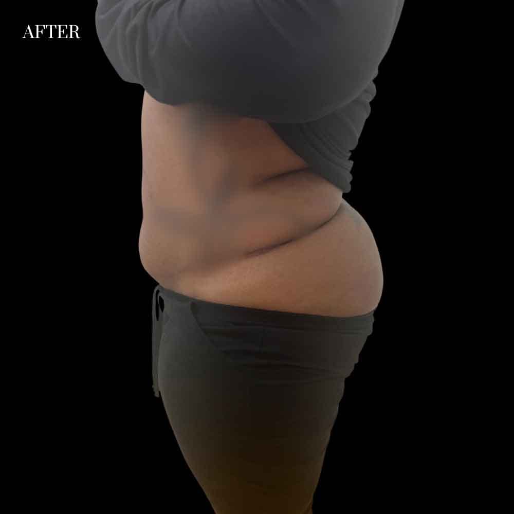 Abdominoplasty Case 3.2 After