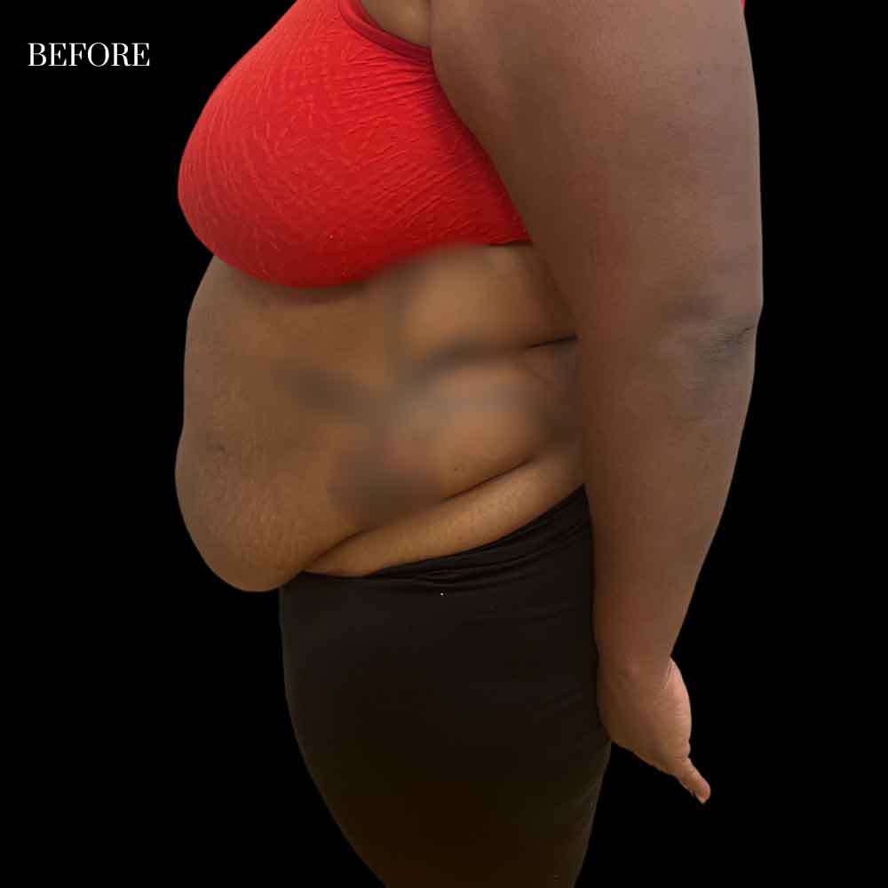 Abdominoplasty Case 2.1 Before