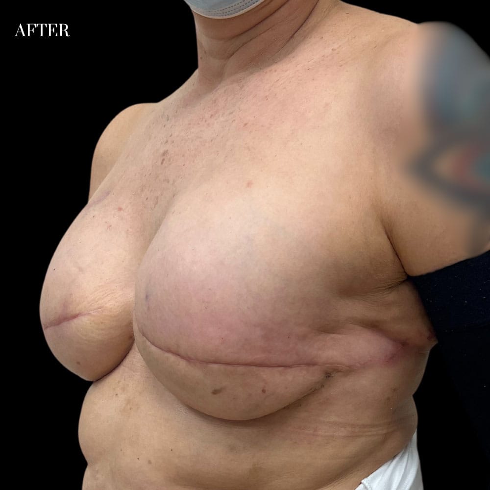 Delayed Reconstruction Case 1.1 Before