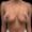 Patient after breast reduction with comfortable size and visible shape improvement.
