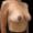 Post-surgery image showing reduced breast size and uplifted appearance.