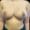 Aesthetic Breast, Breast Reduction, Case 1 After Image