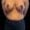 Patient after surgery showing a lighter, lifted appearance and improved symmetry.
