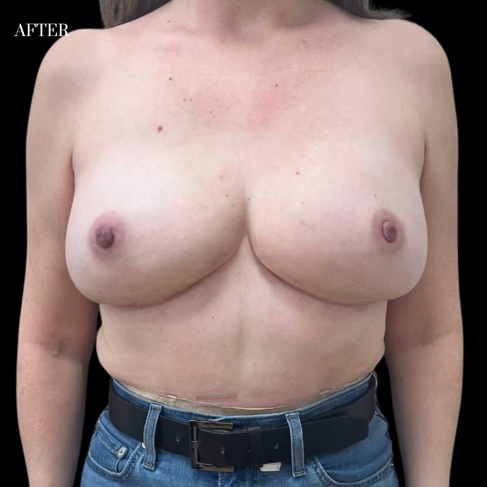 Diep-Flap-Case-2-After-102