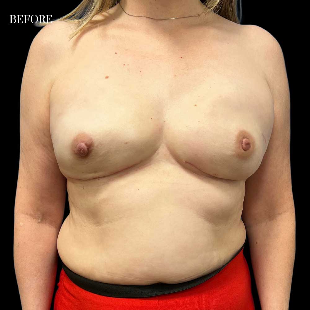 Diep-Flap-Case-2-Before-101