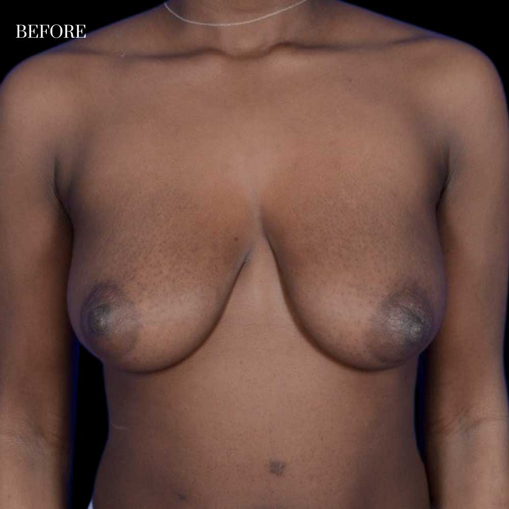 Side profile of patient before mastopexy with downward-facing breasts and skin laxity.