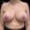 Frontal view after breast lift revealing elevated, reshaped breasts with improved nipple alignment.