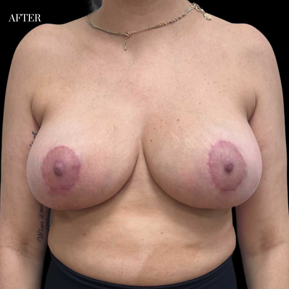 Frontal view after breast lift revealing elevated, reshaped breasts with improved nipple alignment.
