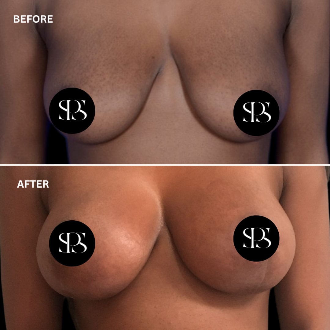 Breast Augmentation with Lift (Mastopexy) in Harrison, NY: What You Need to Know