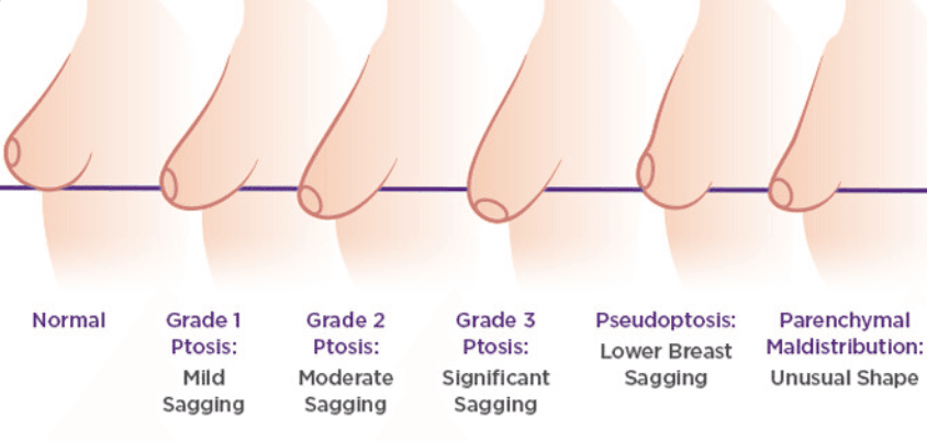 What is Breast Ptosis?