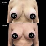 breast implant removal Westchester NY, explant with lift and fat grafting, natural breast enhancement Westchester County, fat transfer breast augmentation Tri-State Area, breast lift after implant removal, Westchester plastic surgeon