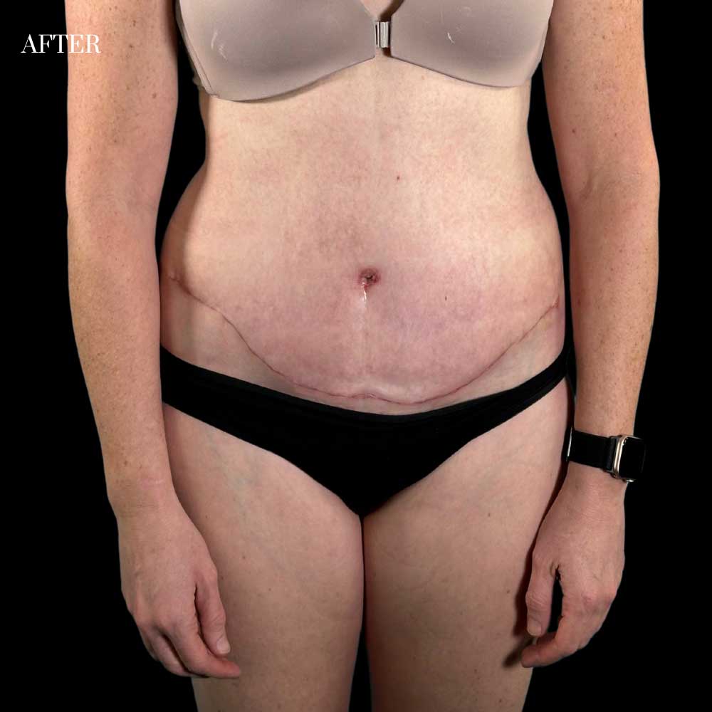 Abdominoplasty After