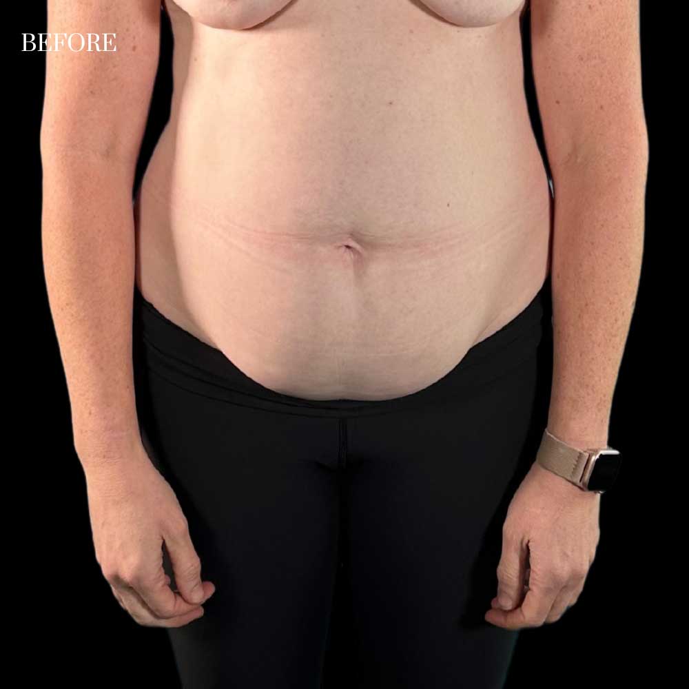 Abdominoplasty Before