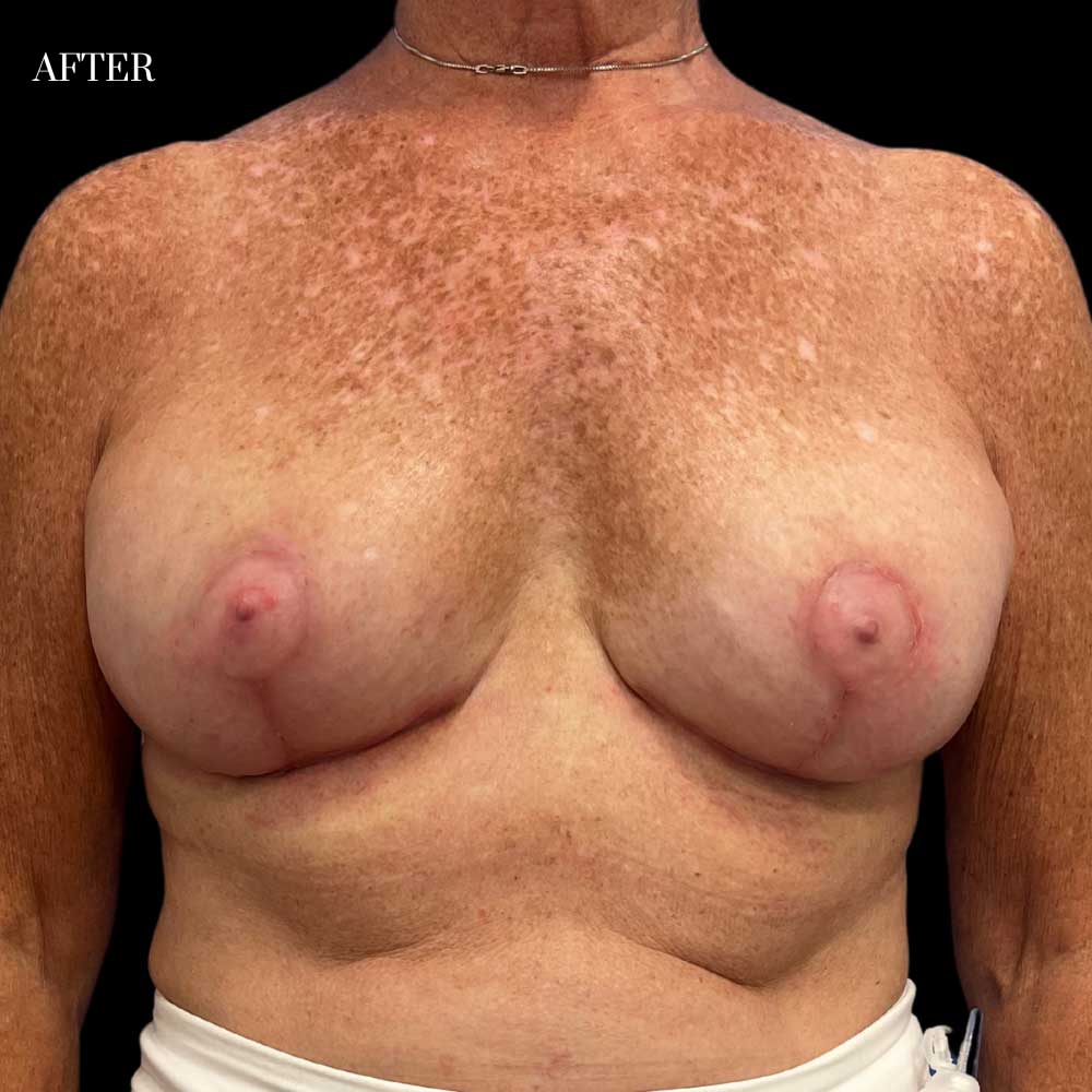 Breast Augmentation Fat Transfer Case 1 After