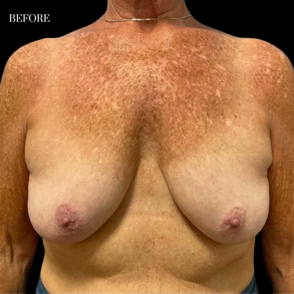 Breast Augmentation Fat Transfer Case 1 Before