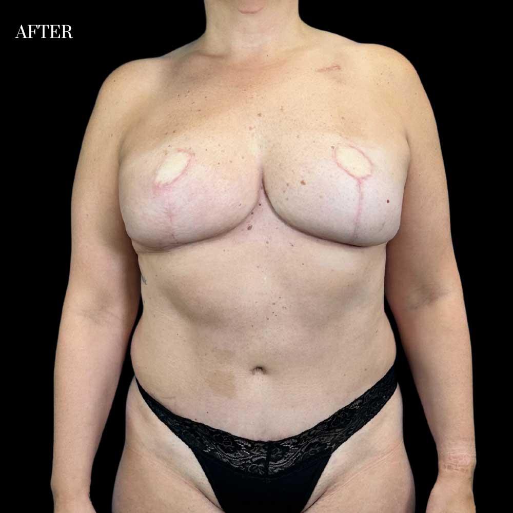 Patient: 38 years old, height: 5’7”, weight: 175 lbs.