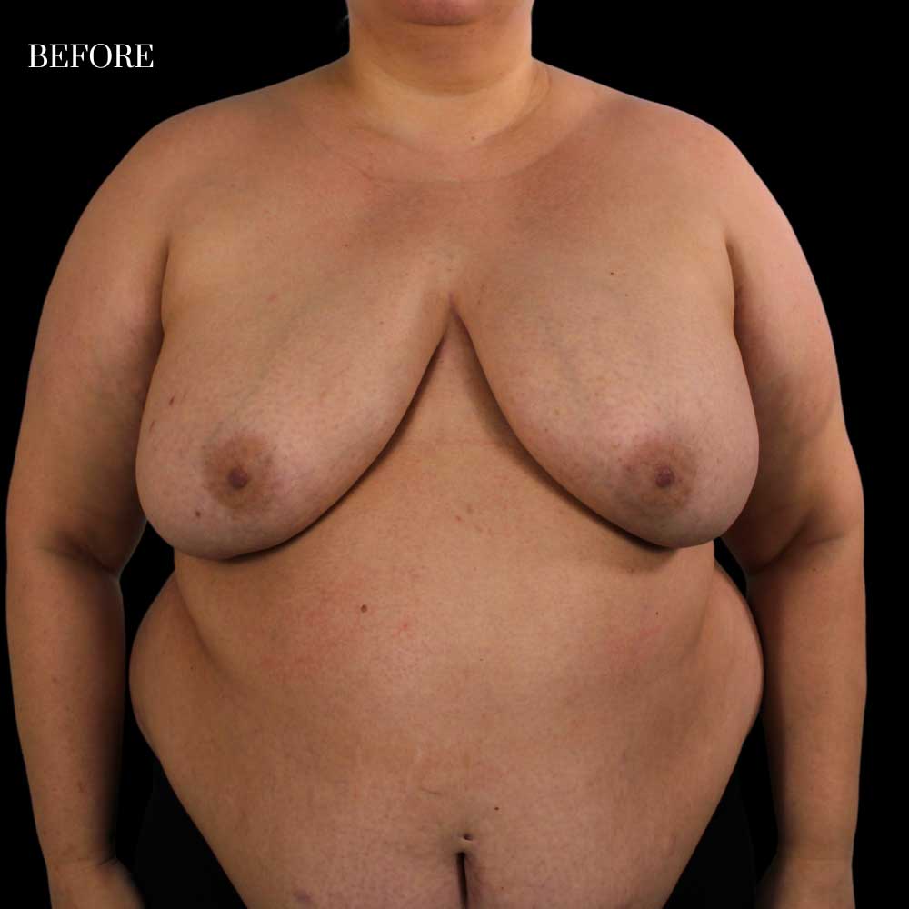 Patient: 38 years old, height: 5’2”, weight: 244 lbs.