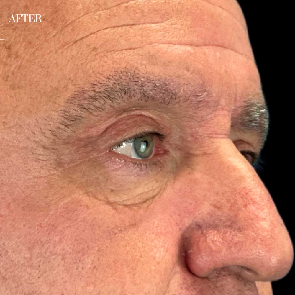 Blepharoplasty Case 1 After