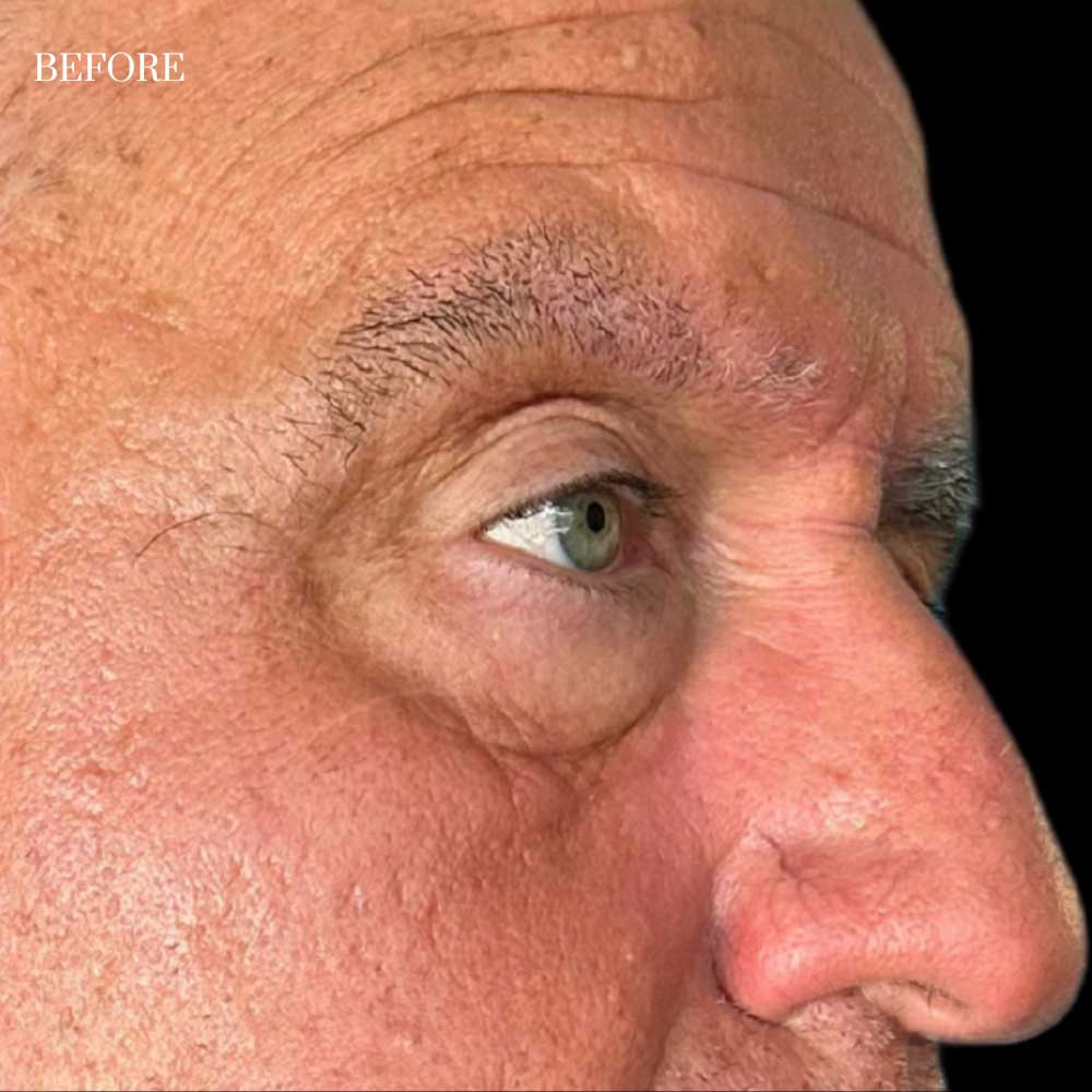 Blepharoplasty Case 1 Before