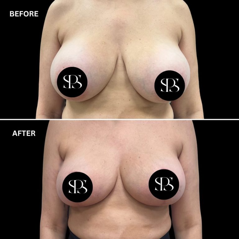 breast implant removal Westchester NY, explant with lift and fat grafting, natural breast enhancement Westchester County, fat transfer breast augmentation Tri-State Area, breast lift after implant removal, Westchester plastic surgeon