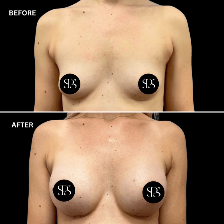 Breast Augmentation with Lift in Westchester County, NY: The Dual-Plane Technique Explained