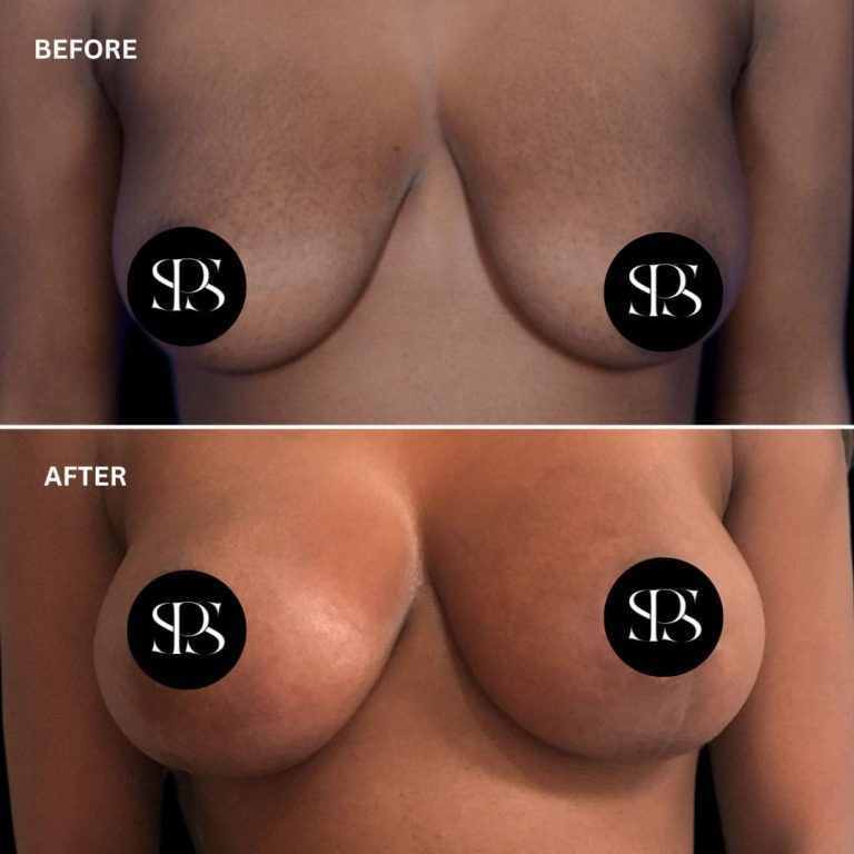 Breast Augmentation with Lift (Mastopexy) in Harrison, NY: What You Need to Know