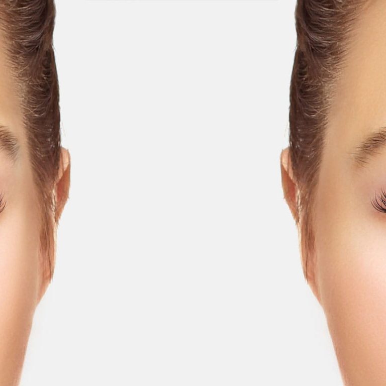 Refresh Your Look with Blepharoplasty in Westchester, NY