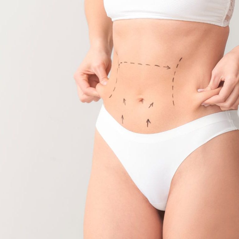 Liposuction and Fat Transfer